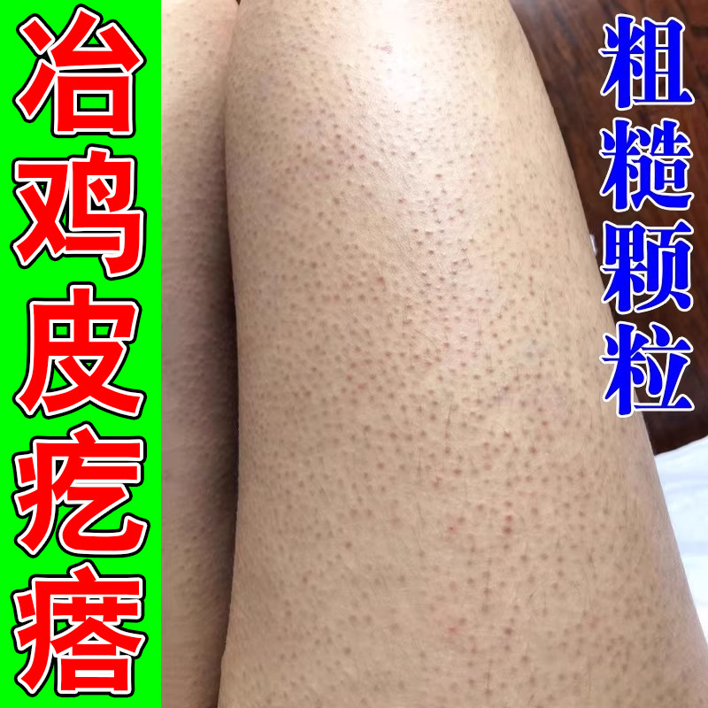 皮肤疙瘩毛囊腿上毛囊粗糙小颗粒皮肤凸起小黑点腿部大腿小疙瘩药