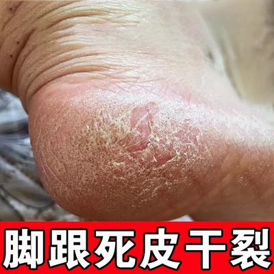 脚后跟干裂起硬皮足跟开裂脚裂手脚起皮修复霜