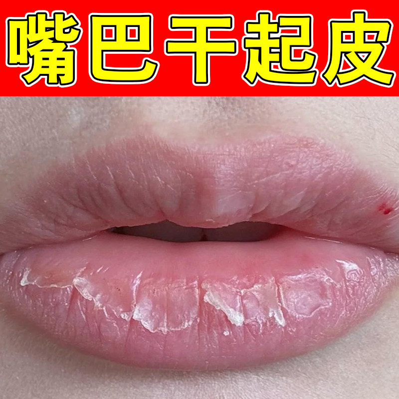 嘴巴发干起皮唇部嘴唇干燥掉皮唇周紧绷起屑舒缓唇部粗糙干裂起皮