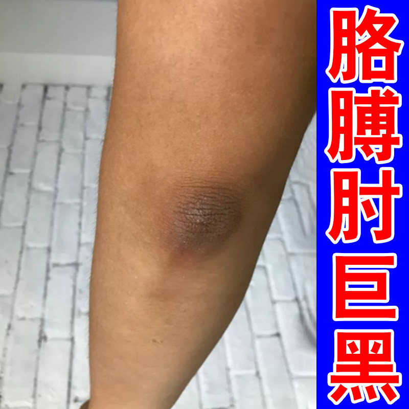去胳膊肘黑皮肤黑色素沉淀除儿童脖子黑洗不干净膝盖手肘关节黑