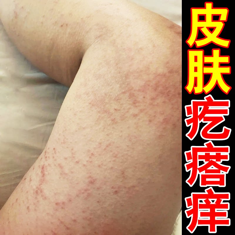 身上痒起红疙瘩痒腿部皮肤过敏起小红点痒小腿长痘大腿内侧痒软膏