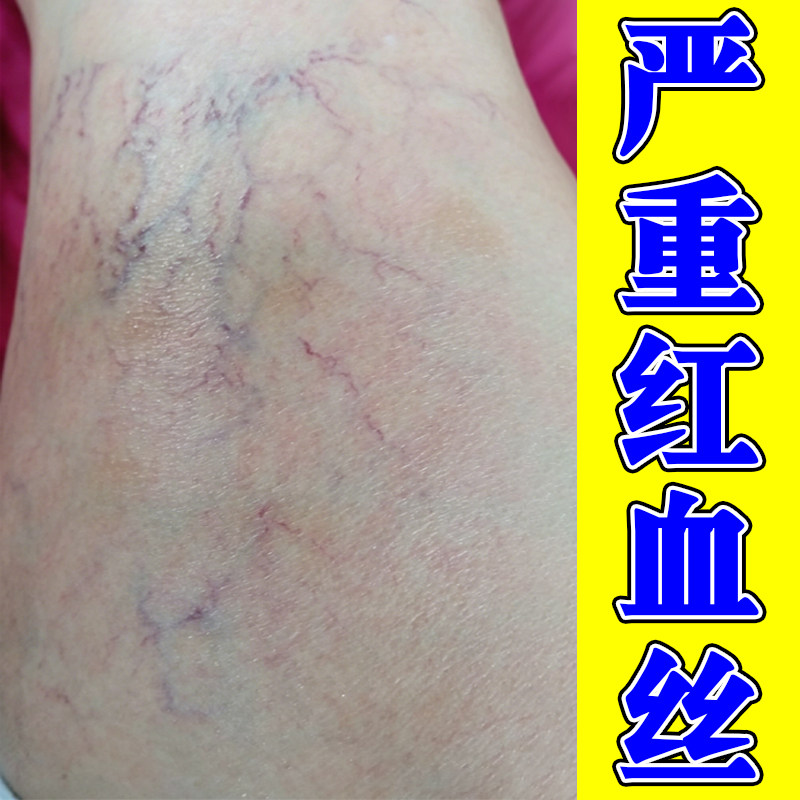 严重红血丝腿上毛细血管扩张腿上有红血丝修复血丝腿外用软膏