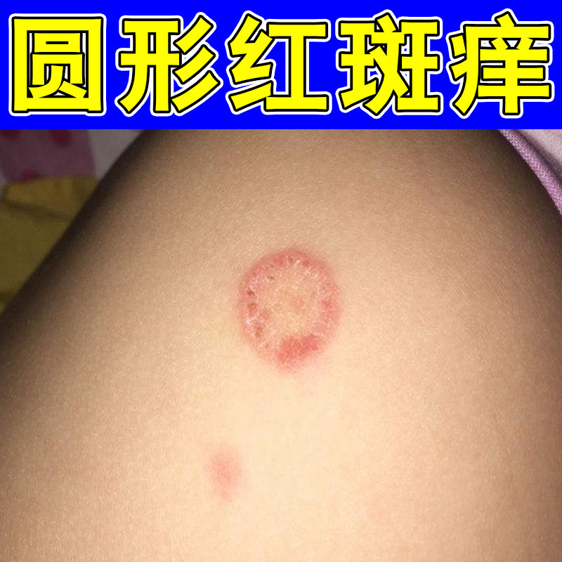 圆形红斑痒铜钱疙瘩过敏外用皮肤干燥粗糙身上起皮掉屑痒软膏乳药
