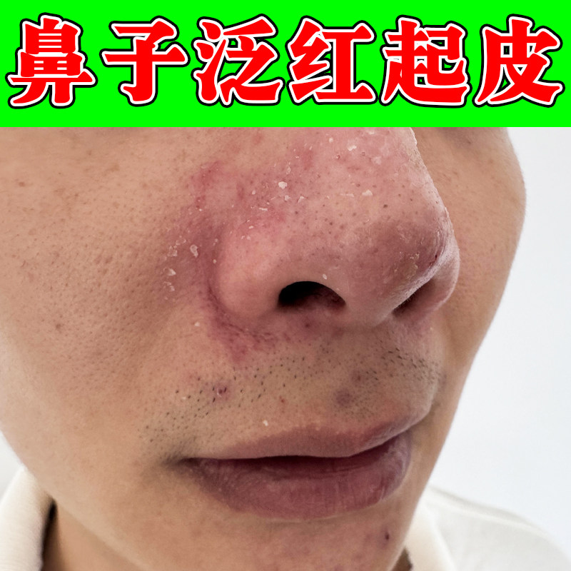 鼻子泛红起皮掉屑红鼻头油腻螨虫痘小疙瘩鼻翼两侧泛红修复软膏