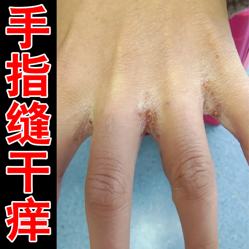 手指缝干痒粗糙起皮掉屑夜间刺痒手上长小水泡又痒又脱皮外用软膏