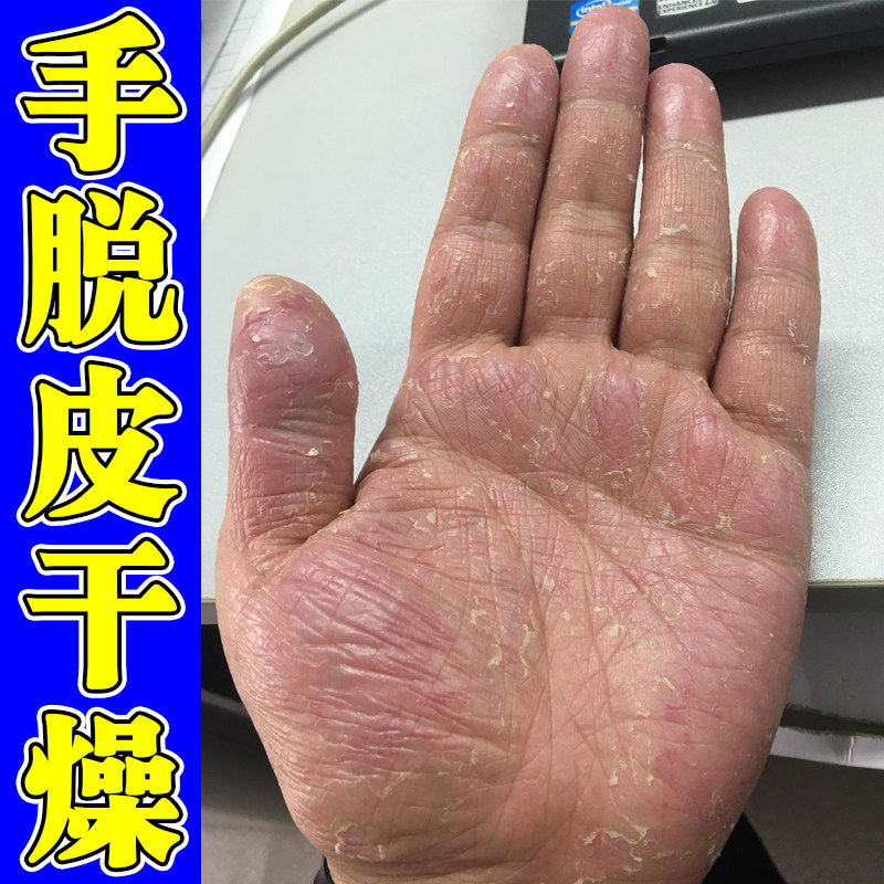 手脱皮干燥粗糙起皮掉皮去死皮换季手掌手指蜕皮真菌手严重脱皮药