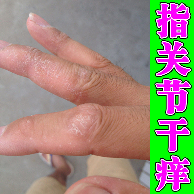 指关节干痒粗糙手起皮脱皮去死皮真菌手足干裂冶手指关节痒的药