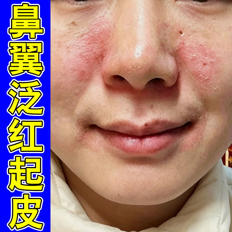 鼻翼泛红起皮干痒鼻子两侧过敏发红溢脂性鼻子干燥粗糙掉皮屑痒