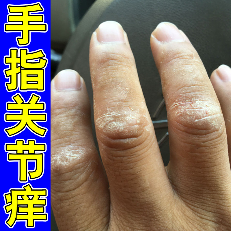手指关节硬干燥粗糙起皮掉屑冶手指头干裂长硬疙瘩神经性皮肤痒