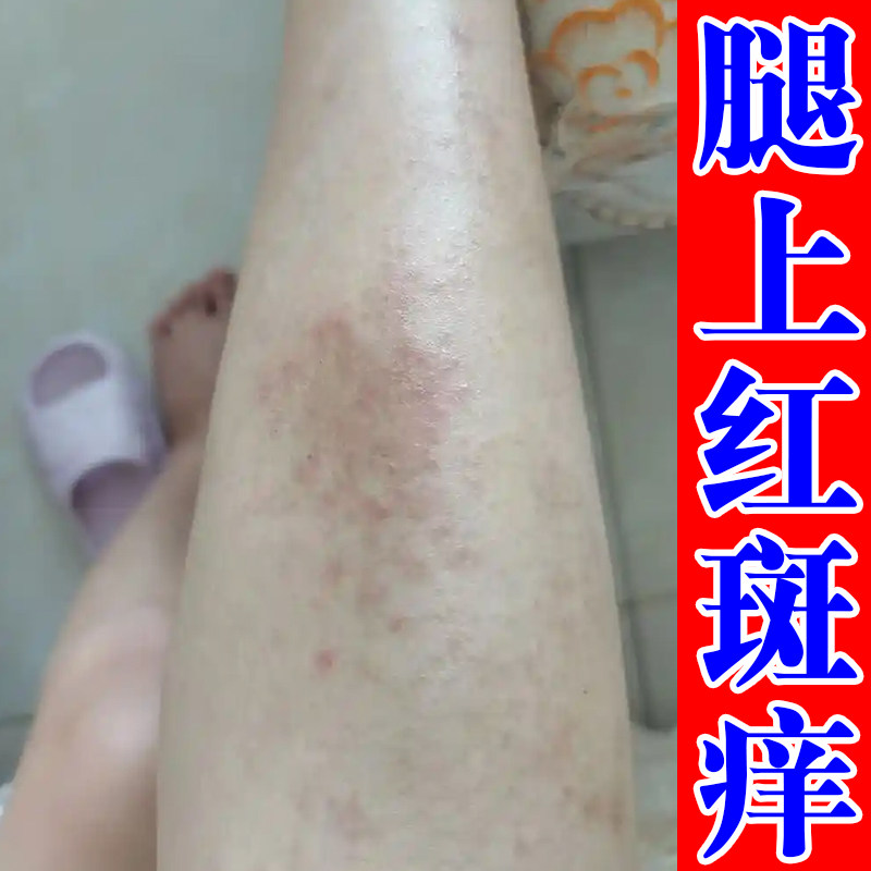 小腿红干疙瘩腿部长小红点腿上干燥粗糙一挠就红疙瘩喷剂
