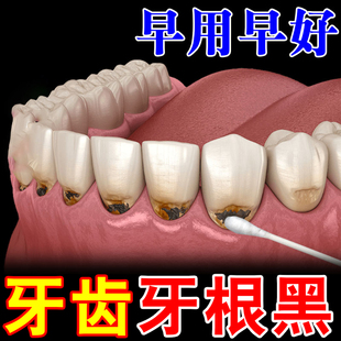 牙根发黑牙垢牙菌斑牙烟渍牙斑净牙缝发黑清理神器牙齿黑氟斑牙药