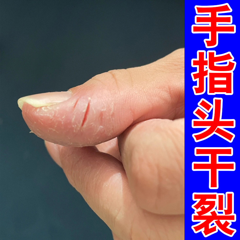 手指头干裂起硬皮脱皮屑真菌手干燥粗糙手蜕皮裂口子专用软膏乳药