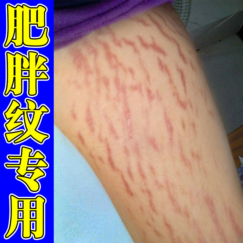 肥胖纹专用修复青少年学生大腿身上长肥胖纹生长纹专用乳膏