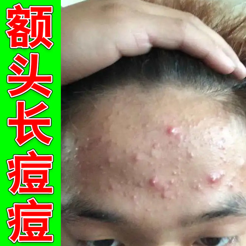 额头上长痘痘青春痘外用膏青少年额头长疙瘩初中生下巴痘痘修复药