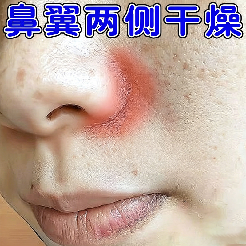鼻翼两侧发红起皮鼻子两边泛红干燥起皮掉皮痒油腻粗糙干痒专用膏