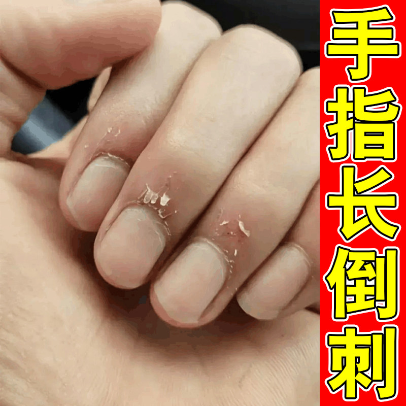 手指长倒刺修复护理有肉刺指甲边缘干裂起皮防倒刺护手霜手脱皮膏
