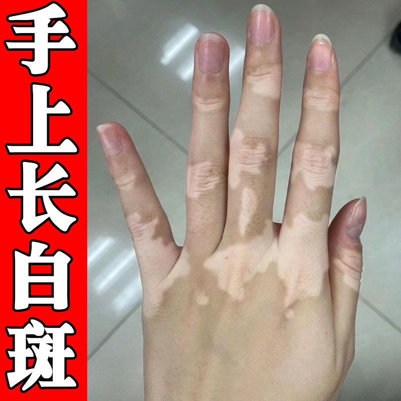 手上长白斑外用修复促进黑色素生长手背长白色斑块专用乳膏