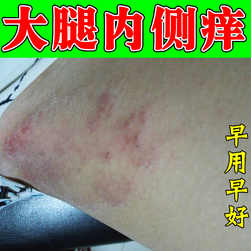 大腿内侧痒起红斑疙瘩干燥粗糙男士阴囊潮湿外用修复腿两侧痒乳膏