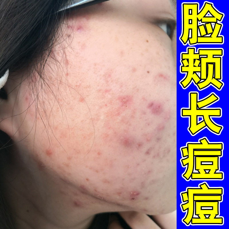 脸颊长痘痘红肿脓包去闭口粉刺痘脸上额头起硬块痘痘外用修复乳膏