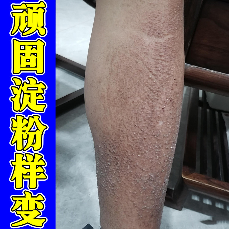 淀粉变小腿黑色素沉淀粗糙颗粒小疙瘩腿上痒小腿痒外用