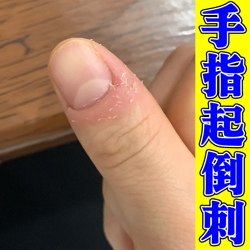 手指起倒刺去死皮疼痛手指头干燥粗糙脱皮起皮指甲边缘防倒刺软膏