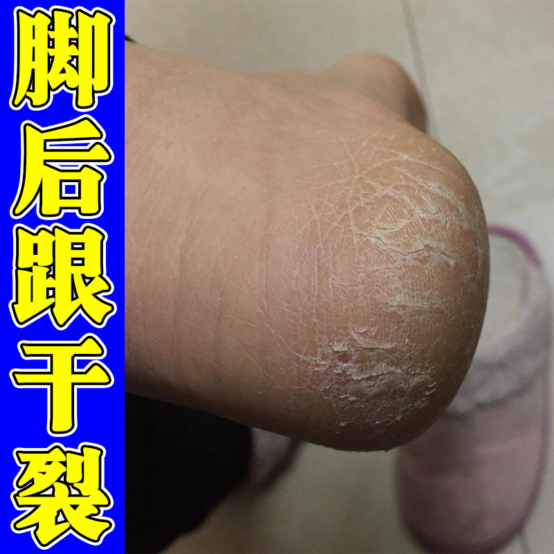 脚后跟干裂角化型皮肤增厚鳞屑脚脱皮干燥裂口子起皮去死皮硬皮药