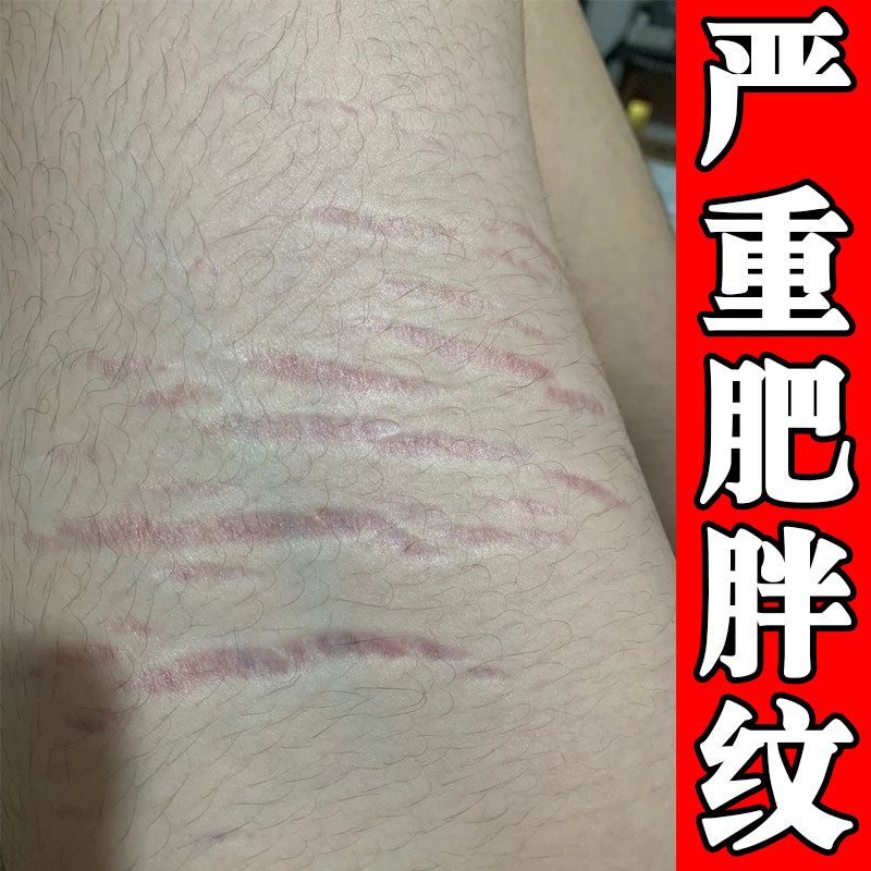 去肥胖纹修复霜生长纹消大腿学生除男淡化纹路祛肥胖纹修复外用膏