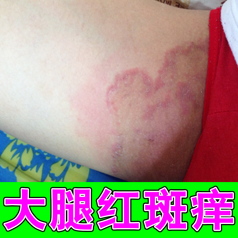 大腿内侧股皮肤痒男士阴囊潮湿外用腿两侧红斑干燥粗糙一挠就痒