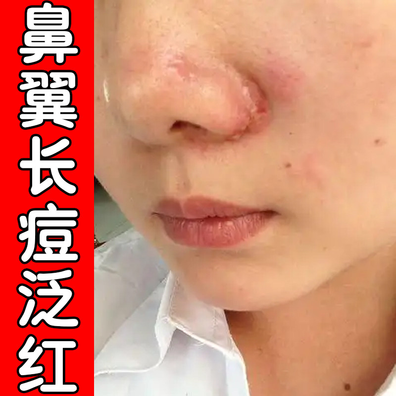 鼻子两侧发红蜕皮鼻翼两边泛红干燥起皮掉皮痒油腻鼻头发红修复膏