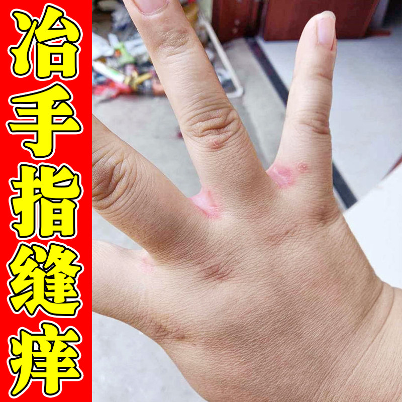 手指缝痒手部指缝肌肤不适换季发痒做家务刺激指缝起小点粗糙干痒
