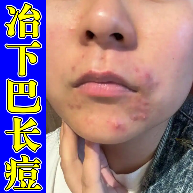 冶下巴长痘内分泌失调嘴周痘红肿男女脸上青春痘专用乳膏