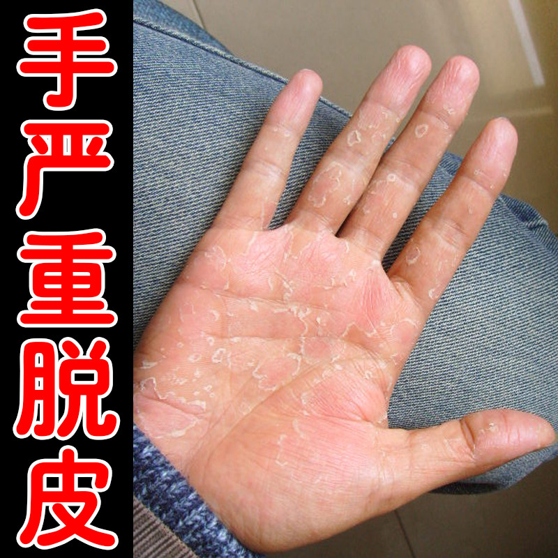手严重脱皮专用膏真菌蜕皮干燥起皮手指手掌去死皮掉屑手脚干裂药