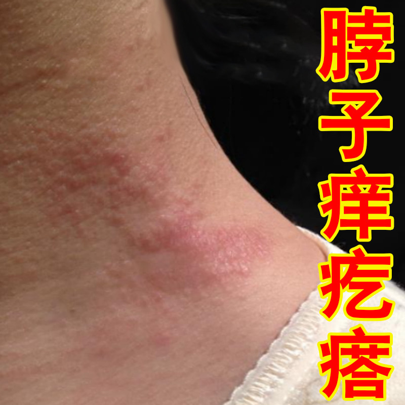 脖子痒疙瘩皮肤过敏红痒刺挠膏夏天热太阳晒出汗多起红疙瘩痒