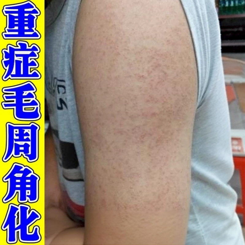 去手臂鸡皮疙瘩胳膊上长小颗粒毛周囊角化角质红点黑点药专用乳膏