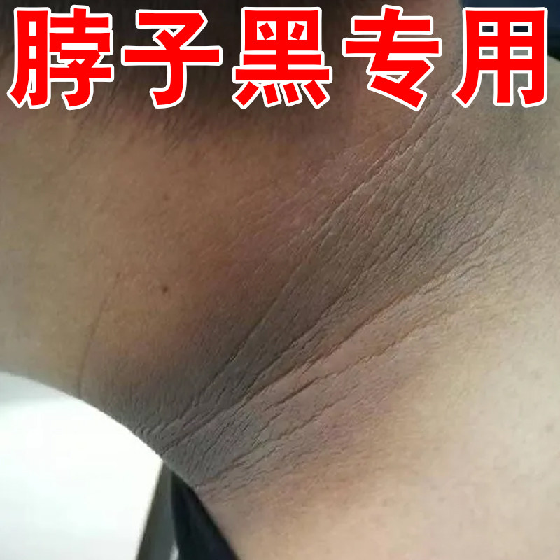 脖子黑专用夏天身体皮肤变黑儿童成人脖子后面黑的外用黑色素沉淀