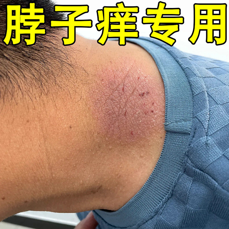 脖子上长红疙瘩皮肤过敏红痒刺挠颈部红斑疙瘩小红点干痒专用软膏