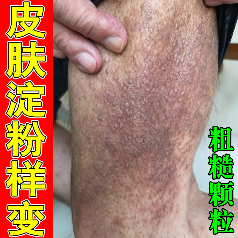 皮肤淀粉样变专用冶疗顽固皮斑痒小腿皮肤痒长粗糙小颗粒疙瘩软膏