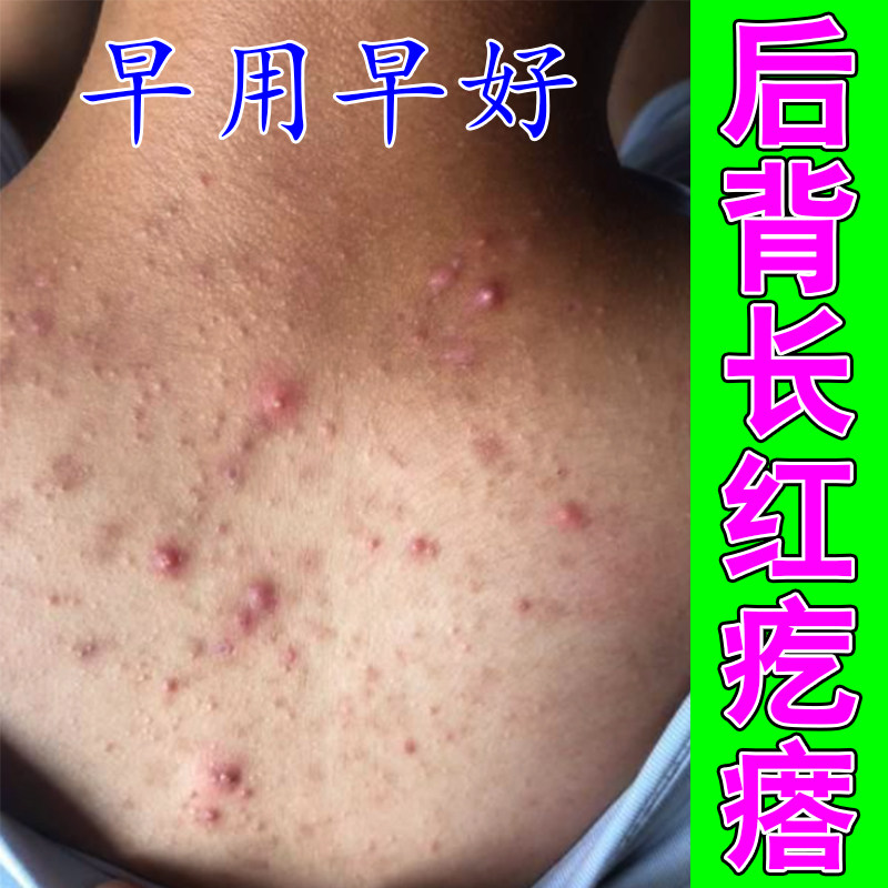 后背长红疙瘩痘痘感染起红疙瘩皮肤痒前胸后背长痘痘毛囊堵塞严重
