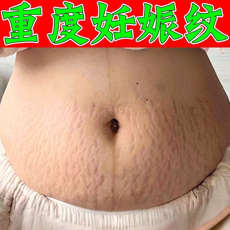 妊娠纹产后消除紧致肚皮产后修复霜消除肥胖纹生长纹淡化紧致乳膏