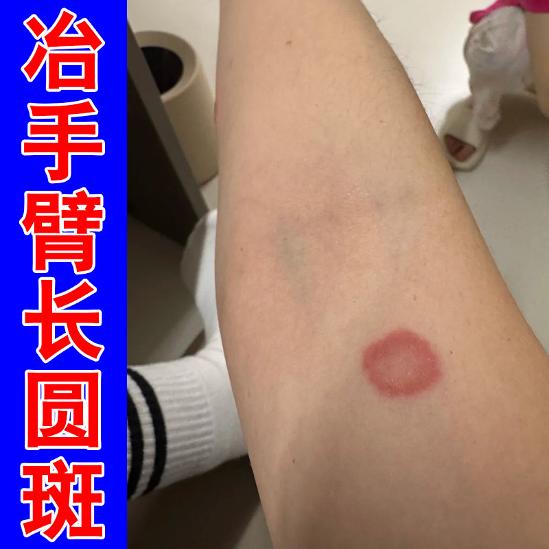 手臂长圆斑红点皮肤痒专用手臂长铜钱状红斑皮肤痒外用草本修护膏