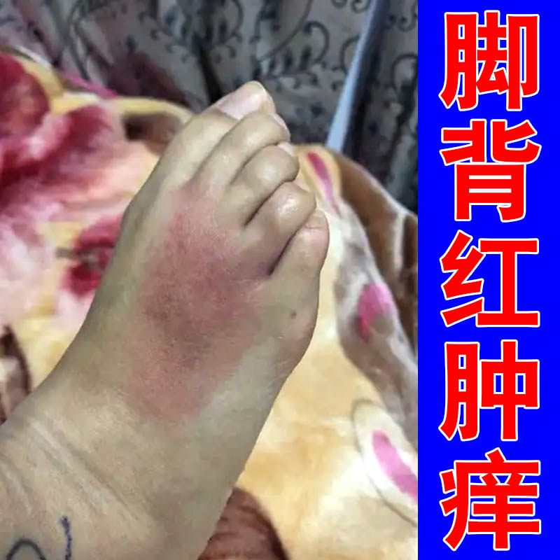 脚背红肿痒脚踝上长斑皮肤干燥起皮掉屑脚脖子痒过敏感染专用乳膏