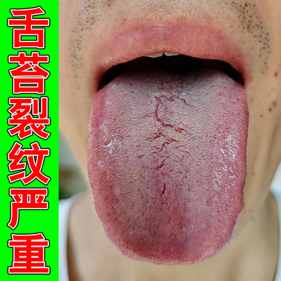 舌苔白厚舌头裂纹口臭口干苦有齿痕舌苔白厚舌头裂纹专用草本喷剂