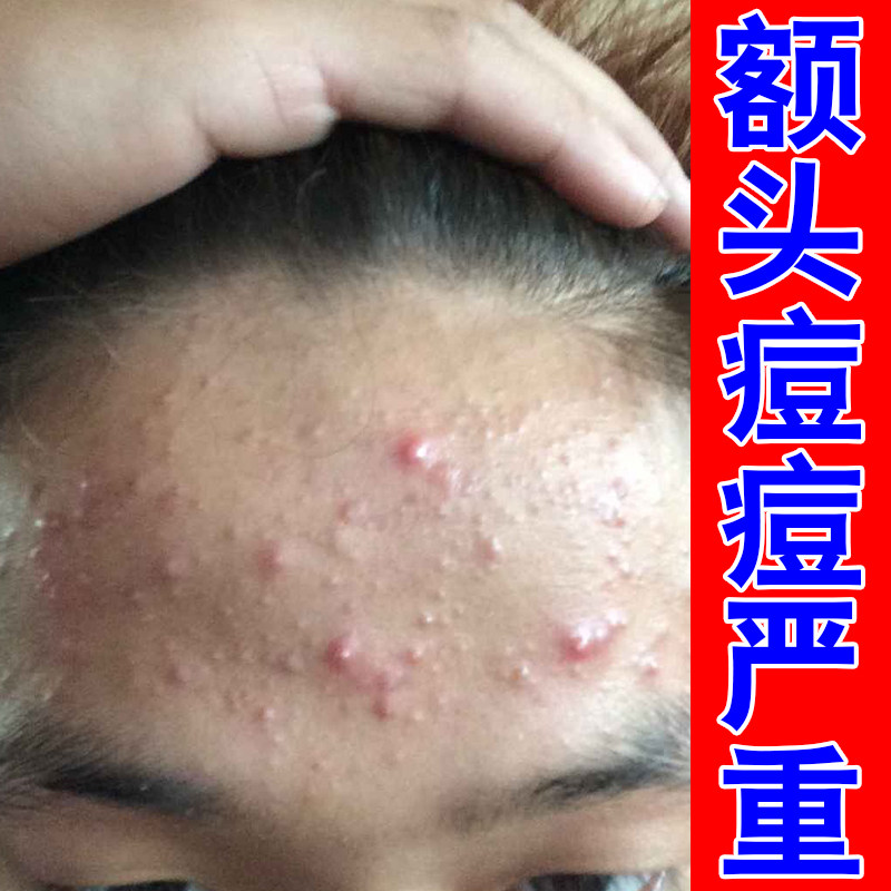 额头痘痘严重脸上长小疙瘩青春痘专用草本修护乳膏男女生额头痘痘