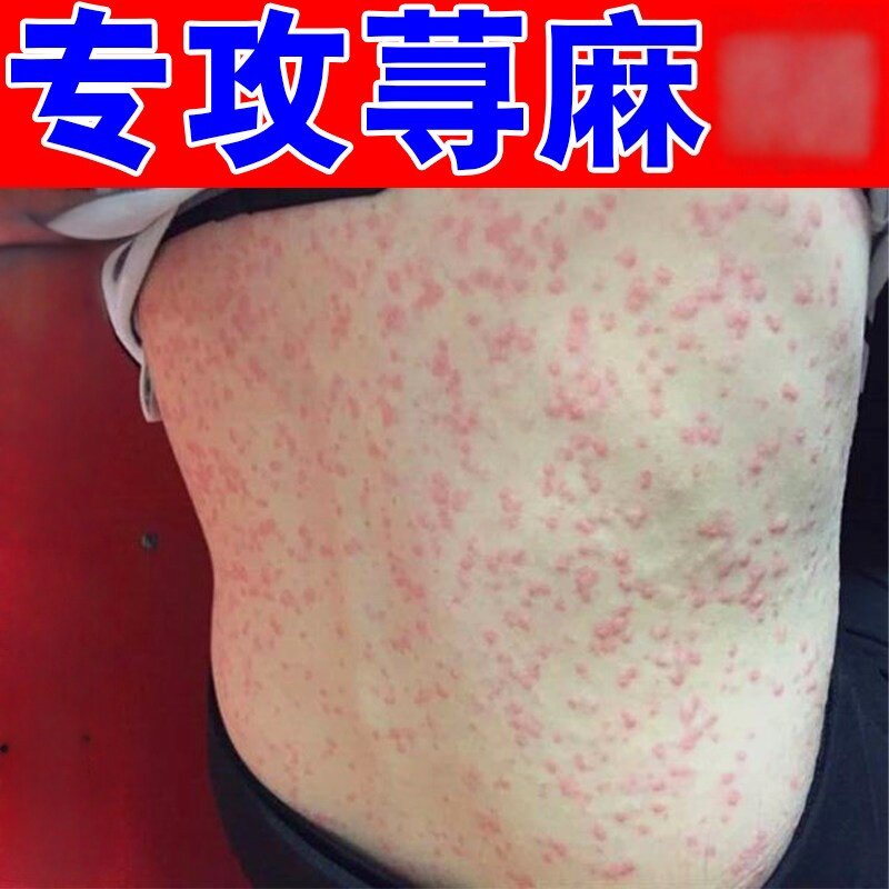 荨寻麻【疹】过敏痒专用全身起红疙瘩痒急慢性风团划痕型专用膏