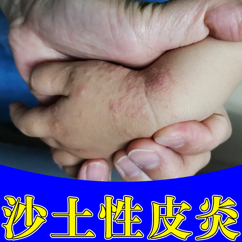 沙土性皮炎儿童柳絮花粉过敏日光性治手背手腕长小疙瘩水泡外用膏