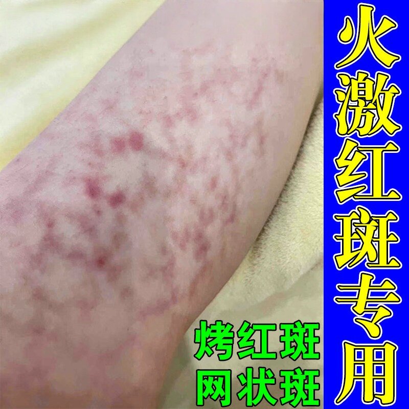 火激红斑药修复高温低温烫伤红色血管扩张性网状红斑烤火后起红斑