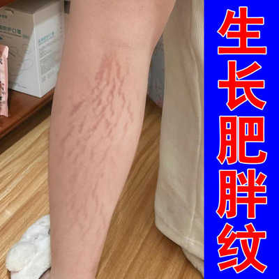 冶肥胖纹生长纹妊辰纹小腿肚子妊娠纹肥胖纹修复霜专用草本乳膏