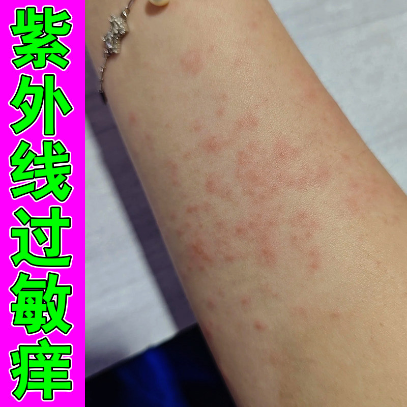 紫外线过敏严重皮肤红肿痒手臂腿上过敏痒起痘痘紫换季皮肤干燥