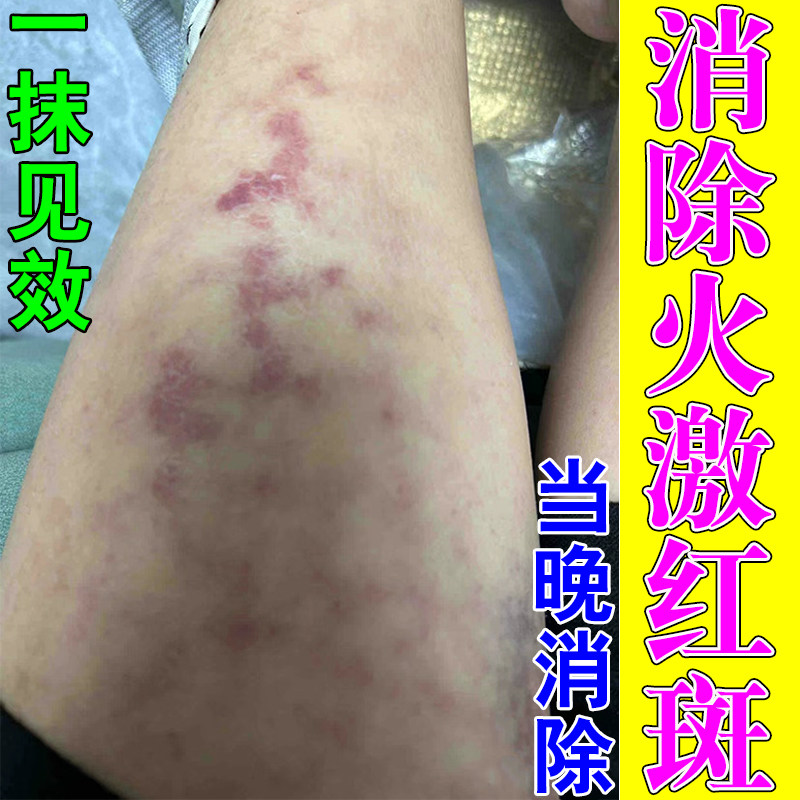 火激红斑药修护膏专攻烤火斑换季腿部网状红斑低温烫伤小腿长水泡
