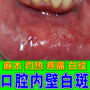 口腔内壁长白斑念珠菌舌面溃烂感染疼痛吞咽有灼烧感扁平糜烂黏膜